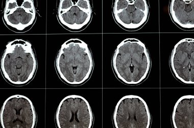 Beyin tomografisi beyin tomografisi gösteriyor ki beyin sapması, sağ merkezde semiovale gelişimsel venöz anomali, serebral hematom, medulla oblongata ve pontomedullary bağlantı noktalarında soluk yoğunlukta lezyon.