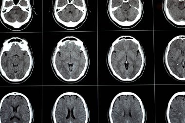 Beyin tomografisi beyin tomografisi gösteriyor ki beyin sapması, sağ merkezde semiovale gelişimsel venöz anomali, serebral hematom, medulla oblongata ve pontomedullary bağlantı noktalarında soluk yoğunlukta lezyon.