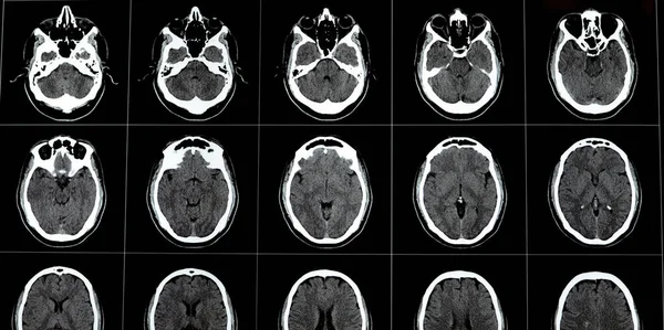 脳幹細胞腫を示す脳Ctスキャン 右半血管発達異常 脳内腫 メドゥラ オブロンガータにおける虚偽偽の催眠病変 およびプルメドメデドララリージャンクション — ストック写真