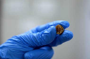 Laparoskopik kolesistektomiden sonra büyük safra taşı cerrahi olarak alındığında safra taşı, safra kesesinde iki tip kolesterol ve pigment taşıyla oluşabilecek sertleştirilmiş hazımsal sıvı birikintileridir.