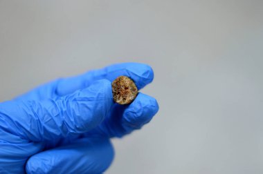 Laparoskopik kolesistektomiden sonra büyük safra taşı cerrahi olarak alındığında safra taşı, safra kesesinde iki tip kolesterol ve pigment taşıyla oluşabilecek sertleştirilmiş hazımsal sıvı birikintileridir.