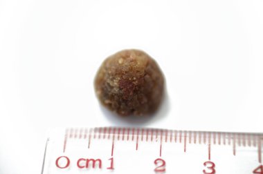 Laparoskopik kolesistektomiden sonra büyük safra taşı cerrahi olarak alındığında safra taşı, safra kesesinde iki tip kolesterol ve pigment taşıyla oluşabilecek sertleştirilmiş hazımsal sıvı birikintileridir.