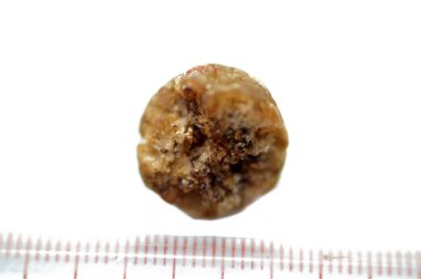 Laparoskopik kolesistektomiden sonra büyük safra taşı cerrahi olarak alındığında safra taşı, safra kesesinde iki tip kolesterol ve pigment taşıyla oluşabilecek sertleştirilmiş hazımsal sıvı birikintileridir.