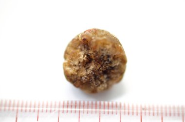 Laparoskopik kolesistektomiden sonra büyük safra taşı cerrahi olarak alındığında safra taşı, safra kesesinde iki tip kolesterol ve pigment taşıyla oluşabilecek sertleştirilmiş hazımsal sıvı birikintileridir.