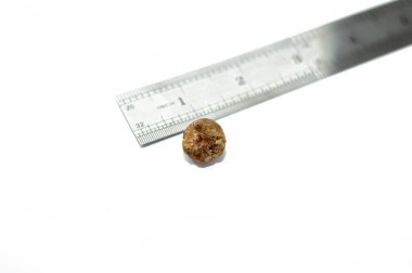 Laparoskopik kolesistektomiden sonra büyük safra taşı cerrahi olarak alındığında safra taşı, safra kesesinde iki tip kolesterol ve pigment taşıyla oluşabilecek sertleştirilmiş hazımsal sıvı birikintileridir.