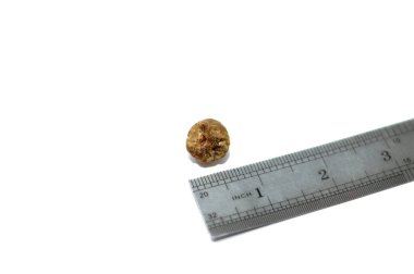 Laparoskopik kolesistektomiden sonra büyük safra taşı cerrahi olarak alındığında safra taşı, safra kesesinde iki tip kolesterol ve pigment taşıyla oluşabilecek sertleştirilmiş hazımsal sıvı birikintileridir.