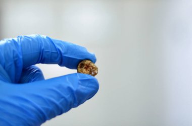 Laparoskopik kolesistektomiden sonra büyük safra taşı cerrahi olarak alındığında safra taşı, safra kesesinde iki tip kolesterol ve pigment taşıyla oluşabilecek sertleştirilmiş hazımsal sıvı birikintileridir.