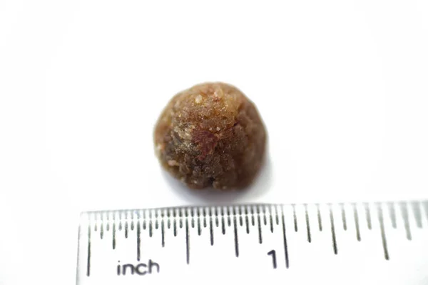 腹腔鏡のコレステロール細胞切除後に外科的に除去された大きな石は 2つのタイプ コレステロールおよび顔料の石で胆嚢に形成することができる消化液の硬化した堆積物です — ストック写真