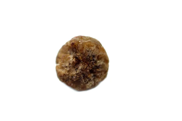 Duży Kamień Żółciowy Usunięty Chirurgicznie Laparoskopowej Cholecystektomii Kamienie Żółciowe Utwardzane — Zdjęcie stockowe