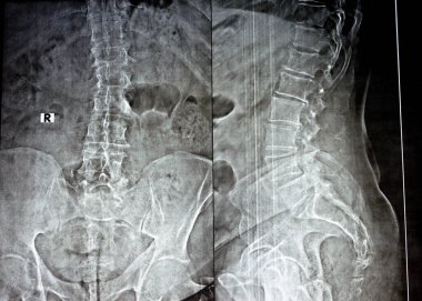 AP 'deki kereste omurgasının sade x ışını ve yanal görüntüler, vertebral uç plakaların marjinal anterior osteofizik dudak bükülmesi, alt kereste intervertebral disk alanlarının azaltılması, seçici odaklanma