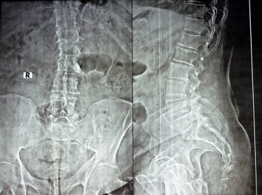 AP 'deki kereste omurgasının sade x ışını ve yanal görüntüler, vertebral uç plakaların marjinal anterior osteofizik dudak bükülmesi, alt kereste intervertebral disk alanlarının azaltılması, seçici odaklanma