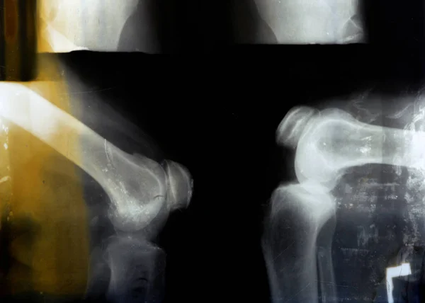 Altes Retro Röntgenbild Des Rechten Knies Zeigt Offensichtliche Gelenkarthrose Durch — Stockfoto