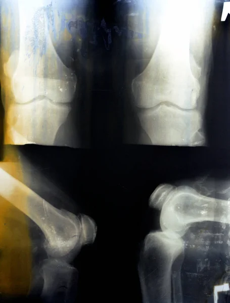 Vieja Radiografía Retro Llana Rodilla Derecha Muestra Osteoartritis Articular Aparente —  Fotos de Stock