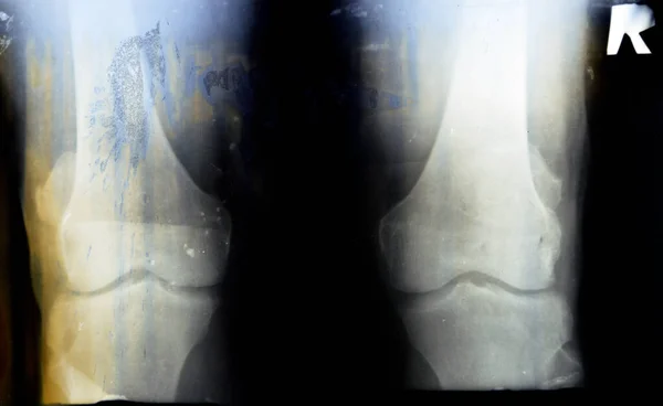 Stare Retro Promienie Rentgenowskie Prawego Kolana Pokazują Pozorne Zapalenie Kości — Zdjęcie stockowe