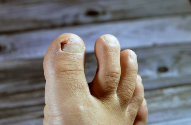 Sağ ayak başparmağının kanaması, ayak parmağının aşağılanması, tedavi ve bandaj gerektiren kanamaya yol açan bir yara, tırnağın üzerinde tıbbî müdahaleye ihtiyacı olan kan.