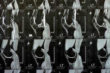 Sol diz eklem MR 'ı, çok az eklem efüzyonu, PHMM Posterior Horn Medial Menisküs dejenerasyonu, ACL ön çapraz bağdoku burkulması, normal MCL, LM, LCL, bağlar, damarlar ve sinirler gösteriyor.