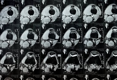 Sol diz eklem MR 'ı, çok az eklem efüzyonu, PHMM Posterior Horn Medial Menisküs dejenerasyonu, ACL ön çapraz bağdoku burkulması, normal MCL, LM, LCL, bağlar, damarlar ve sinirler gösteriyor.