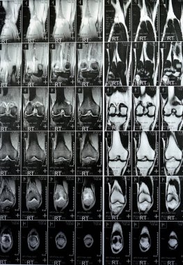 Sağ dizin MRI 'sı normal PHMM, ACL, MCL, LM, bağlar, dizkapakları, dizkapakları, tendonlar, sinirler, kaslar, damarlar, PCL, Hoffa yağ pedi, yumuşak dokular bulgularıyla birlikte hafif eklem efüzyonu gösteriyor.