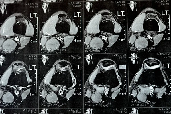 左膝关节Mri表现为轻微关节积液 Phmm后角中半月板变性 Acl前交叉韧带轻度扭伤 正常Mcl Lcl 血管和神经 — 图库照片