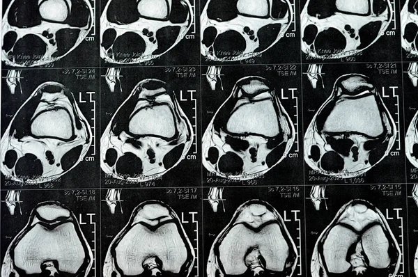 Resonancia Magnética Articulación Rodilla Izquierda Que Muestra Derrame Articular Mínimo —  Fotos de Stock