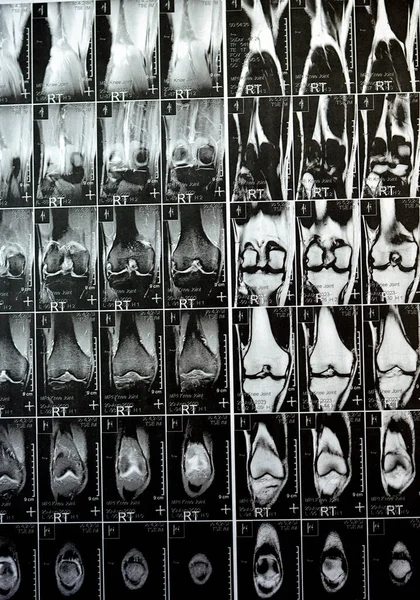 MRI of the right knee showing mild joint effusion, with normal other findings of PHMM, ACL, MCL, LCL, LM, ligaments, patella, tendons, nerves, muscles, vessels, PCL, Hoffa fat pad, soft tissues