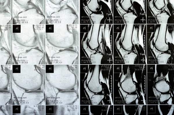 Resonancia Magnética Rodilla Derecha Que Muestra Derrame Articular Leve Con — Foto de Stock
