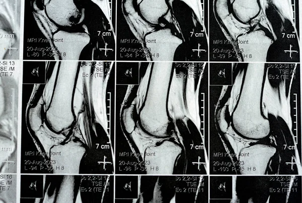 右膝Mri表现为轻度关节积液 与正常的其他发现Phmm Acl Mcl Lcl Patella Pcl Hoffa脂肪垫 软组织 — 图库照片