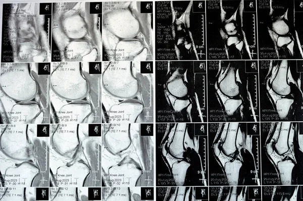 Articulação Joelho Esquerdo Mostrando Derrame Articular Mínimo Phmm Posterior Horn — Fotografia de Stock
