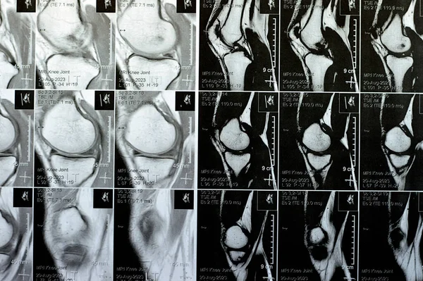 Resonancia Magnética Articulación Rodilla Izquierda Que Muestra Derrame Articular Mínimo — Foto de Stock