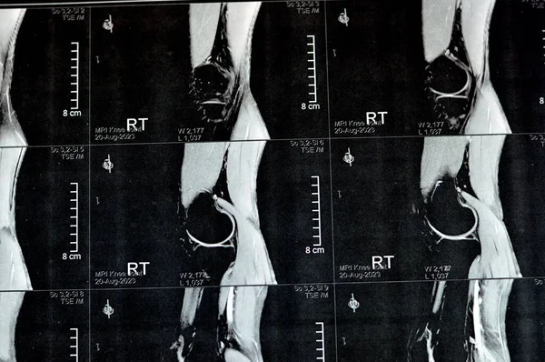 Resonancia Magnética Rodilla Derecha Que Muestra Derrame Articular Leve Con —  Fotos de Stock