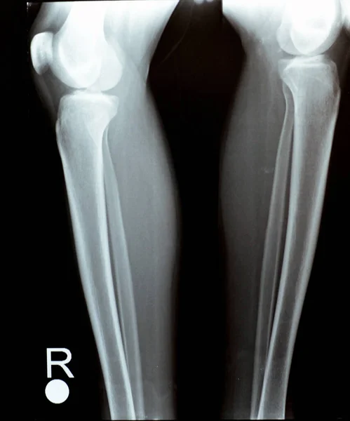 Plain Ray Both Right Left Knee Joints Lower Part Femur — Stock Photo, Image