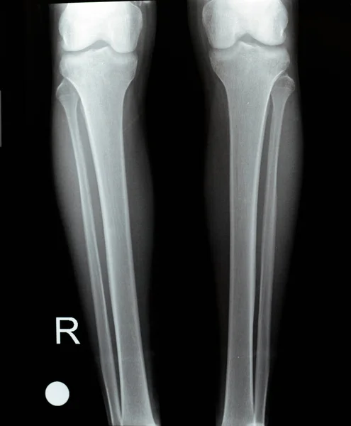 Radiografía Simple Las Articulaciones Derecha Izquierda Rodilla Con Parte Inferior — Foto de Stock