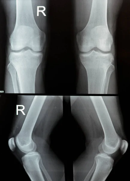 Radiografía Simple Las Articulaciones Derecha Izquierda Rodilla Con Parte Inferior — Foto de Stock