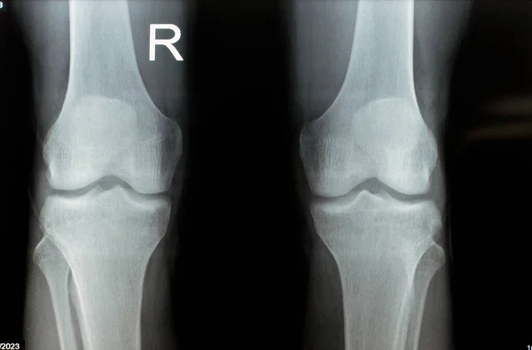 Plain X ray of both right and left knee joints with lower part of femur and upper parts of tibia and fibula and patella showing normal knee join of a young male that complains painful joint for MRI