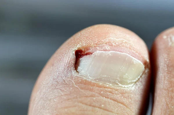 Bleeding of the big toe of the right foot, insult of the foot toe resulting in a bleeding wound that needs care and bandage, blood on toenail that needs medical attention after removing ingrown nail