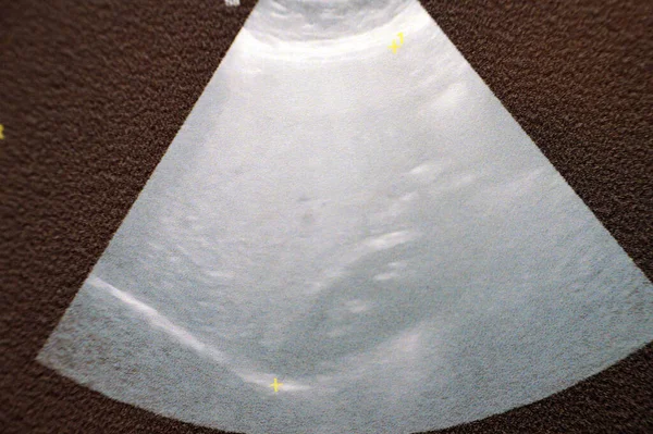 Enlarged liver size 19.7 CM with uniform texture bright, no focal lesions or or dilated IHBRs intrahepatic biliary radicals, P.V Portal vein is not dilated, Real time ultrasound of abdomen and pelvis