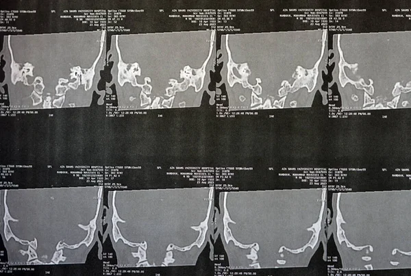 2023年8月30日 エジプト カイロ エジプト2023年8月30日 二国間の慢性耳炎メディアの示唆を示す時間骨のCtスキャン マストイド放出 両方のマストイド空気細胞の不透明化 選択的な焦点 — ストック写真