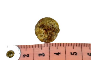 Laparoskopik kolesistektomiden sonra büyük safra taşı cerrahi olarak alındığında safra taşı, safra kesesinde iki tip kolesterol ve pigment taşıyla oluşabilecek sertleştirilmiş hazımsal sıvı birikintileridir.