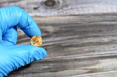 Laparoskopik kolesistektomiden sonra büyük safra taşı cerrahi olarak alındığında safra taşı, safra kesesinde iki tip kolesterol ve pigment taşıyla oluşabilecek sertleştirilmiş hazımsal sıvı birikintileridir.