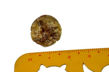 Laparoskopik kolesistektomiden sonra büyük safra taşı cerrahi olarak alındığında safra taşı, safra kesesinde iki tip kolesterol ve pigment taşıyla oluşabilecek sertleştirilmiş hazımsal sıvı birikintileridir.