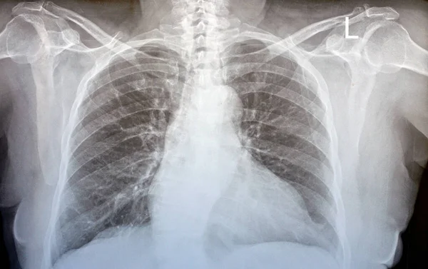 Plain x ray chest of an old woman with almost normal study of bones, lungs and heart, normal chest cavity, ribs and wall, no signs of white patches or pneumonia, with normal sizes and shapes