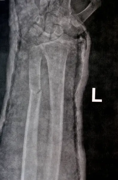 右前臂平滑肌X线片 错误地写在底片上 显示下半部尺骨骨折4周后开始愈合 需要内固定 — 图库照片