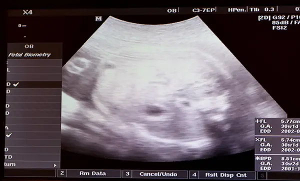 Ultrasonography on the uterus of a pregnant woman showing a healthy fetus, maternal ultrasound during pregnancy, pregnancy follow up and fetus health concept, ultrasonogram medical checkup
