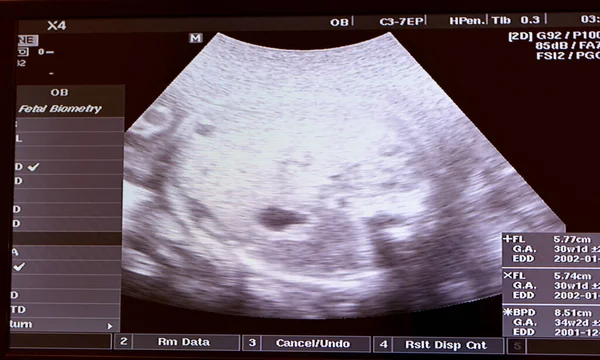 Ultrasonography on the uterus of a pregnant woman showing a healthy fetus, maternal ultrasound during pregnancy, pregnancy follow up and fetus health concept, ultrasonogram medical checkup