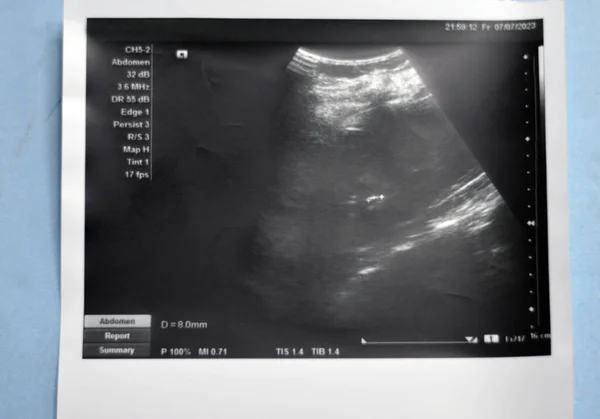 Ultrassonografia Abdominal Mostra 6Mm Pequeno Cálculo Ecogênico 6Mm Cálice Inferior — Fotografia de Stock