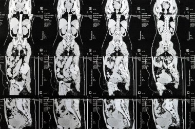 Kahire, Mısır, 3 Ekim 2023: Çoklu kesit CT taraması karın ve pelvis sağ yumurtalık kisti 3 x 3 cm, kolon gazı şişmesi, geniş çaplı idrar ve taş saptanamadı