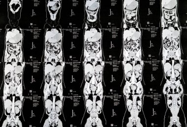 Kahire, Mısır, 3 Ekim 2023: Çoklu kesit CT taraması karın ve pelvis sağ yumurtalık kisti 3 x 3 cm, kolon gazı şişmesi, geniş çaplı idrar ve taş saptanamadı