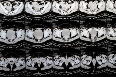 Kahire, Mısır, 3 Ekim 2023: Çoklu kesit CT taraması karın ve pelvis sağ yumurtalık kisti 3 x 3 cm, kolon gazı şişmesi, geniş çaplı idrar ve taş saptanamadı