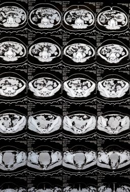 Kahire, Mısır, 3 Ekim 2023: Çoklu kesit CT taraması karın ve pelvis sağ yumurtalık kisti 3 x 3 cm, kolon gazı şişmesi, geniş çaplı idrar ve taş saptanamadı