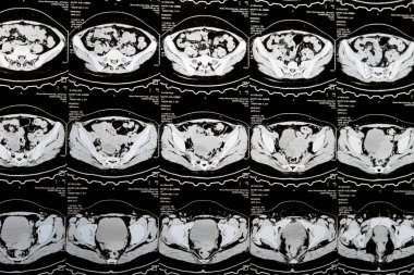 Kahire, Mısır, 3 Ekim 2023: Çoklu kesit CT taraması karın ve pelvis sağ yumurtalık kisti 3 x 3 cm, kolon gazı şişmesi, geniş çaplı idrar ve taş saptanamadı